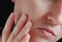 ۱۱ روش مؤثر برای از بین بردن جای جوش